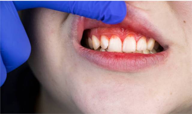 Periodontal Disease: Definition & Causes